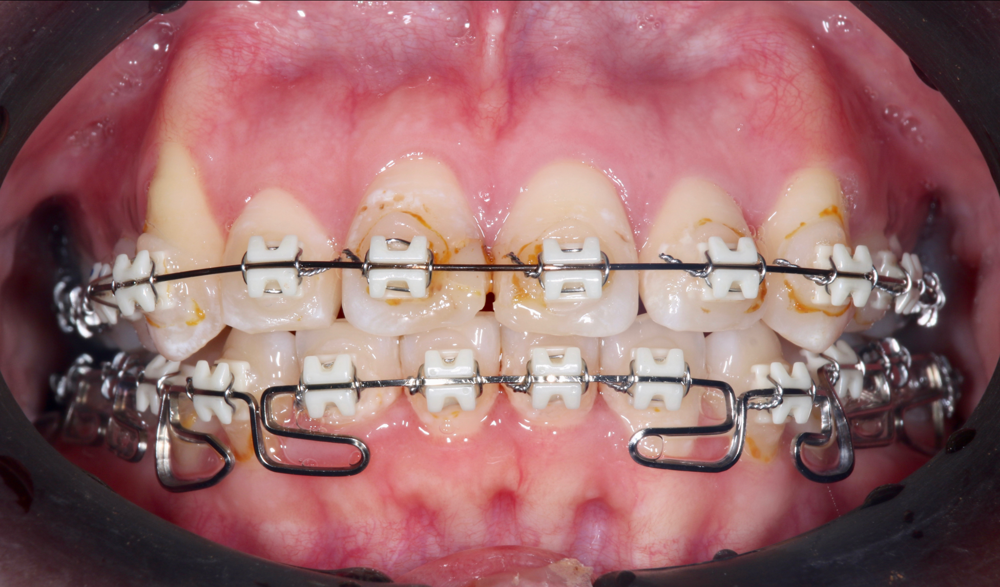 世界的専門医によるインプラント