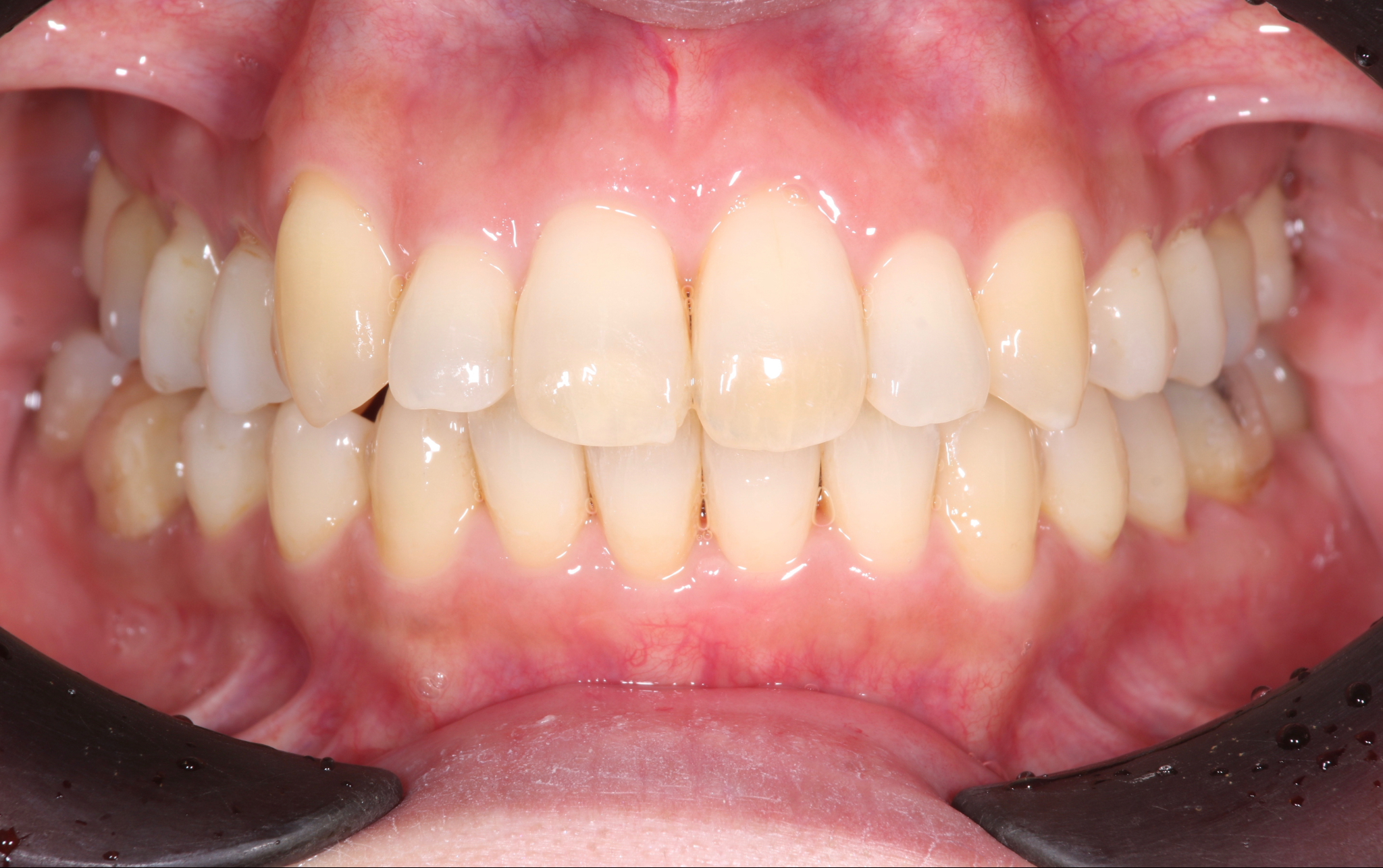 世界的専門医によるインプラント